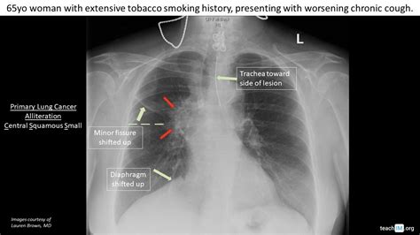 longhili|The Pulmonary Hilus and Lung Cancer